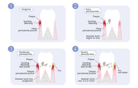 Periodontal Disease Stages