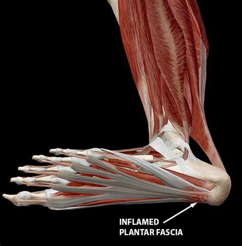 Run With This Anatomy Physiology And Pathology Of Plantar Fasciitis