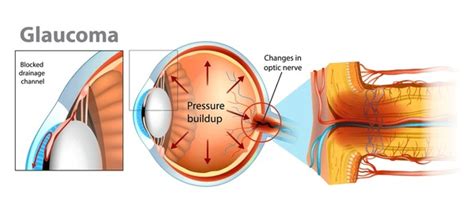 Acute Glaucoma Over 2 Royalty Free Licensable Stock Vectors And Vector Art Shutterstock