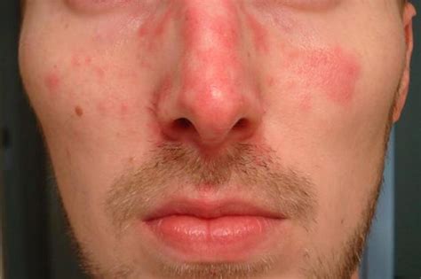 Small Rash On Face