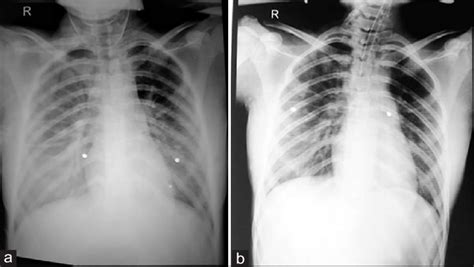 A Chest X Ray Anteroposterior View In Spine Position Taken 3 H Download Scientific Diagram