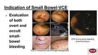 capsule endoscopy   dimension  endoscopy finalpptx