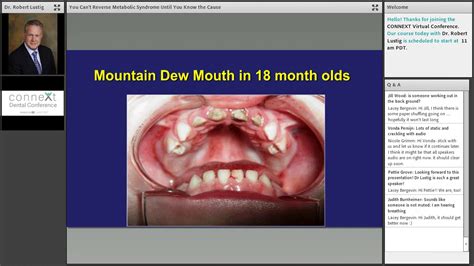 Mountain Dew Mouth Syndrome