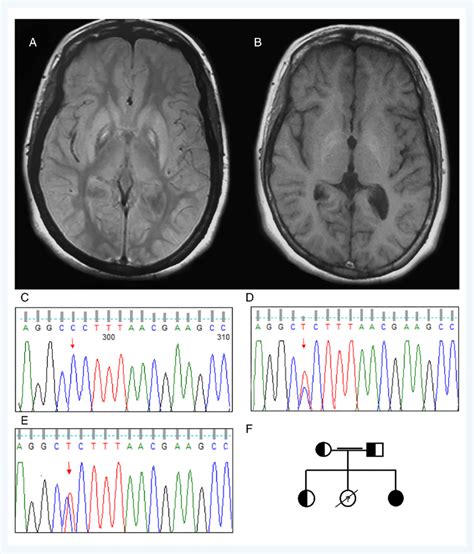 A Brain Mri Of Index Case Showing A Typical Eye Of The Tiger Sign On