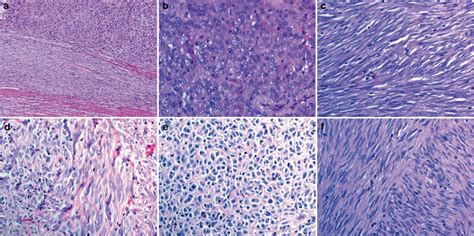 Epithelioid Mixed Phenotype In Gastrointestinal Stromal Tumors With Kit