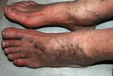 Chronic Venous Insufficiency - Causes, Symptoms & Treatments - MVS