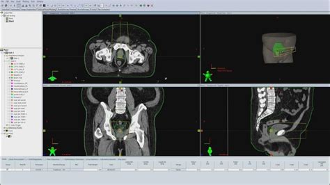 Vmat Prostate And Lymph Nodes Planning Youtube