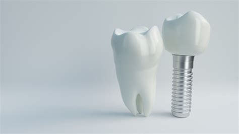 Dental Implant After Tooth Extraction Bellingham Dentist Moreno Dental