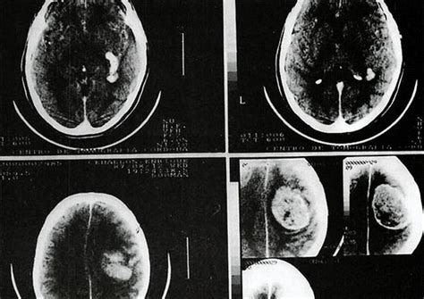 Meningiomas Intracraneanos Revista Argentina De Neurocirugia