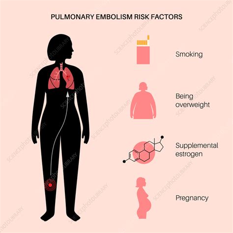 Pulmonary Embolism Illustration Stock Image F036 6475 Science Photo Library