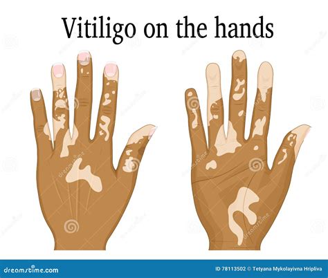 Vitiligo On The Hands. White Spots On The Skin Of The Hands ...