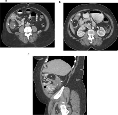 Year Old Woman With Abdominal Pain Found To Have Colocolic