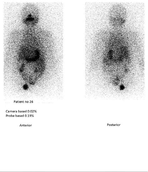 Figure From Comparison Of Radioiodine Uptake By Gamma Camera And