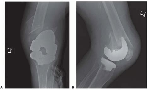 Fixation Of Periprosthetic Fractures Above Total Knee Arthroplasty Musculoskeletal Key