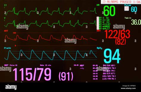 ecg monitoring  interpretation  ken escobar blog