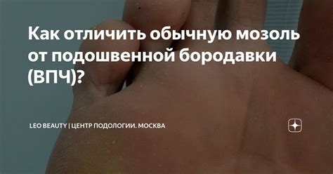 Как отличить обычную мозоль от подошвенной бородавки (ВПЧ)? | Leo ...