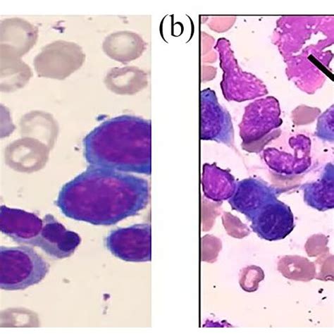 The Morphology Of Bone Marrow Cells The Pathological Result Showed