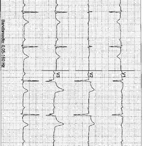 Ecg At Admission Suggestive For An Acute Anterior Wall Infarction