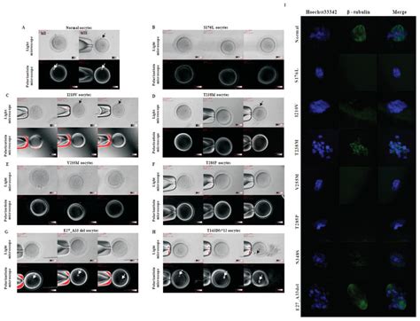 Oocyte Phenotypes From Patients With Maturation Arrest A Normal Oocyte Download Scientific