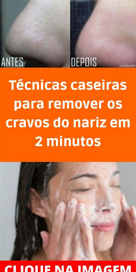 Eu Uso Essa Receita Natural Para Tirara Todos Os Cravos Do Meu Nariz