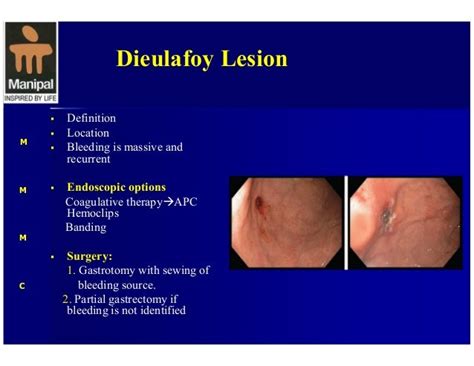 Upper Gi Hemorrhage Surgical Perspective