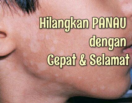 Cara Hilangkan Panau Di Muka Malaysian Today