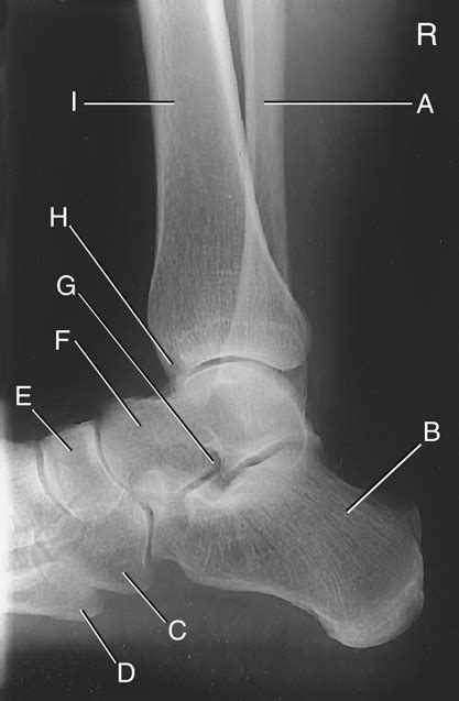 Lower Limb Anatomy- Lateral Ankle Diagram | Quizlet