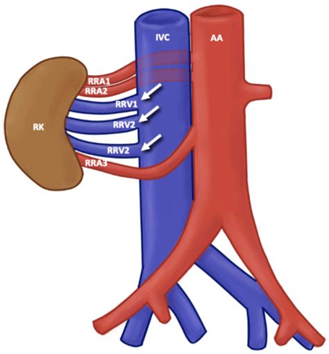 Jcm Free Full Text Anatomical Variants Of The Renal Veins And Their