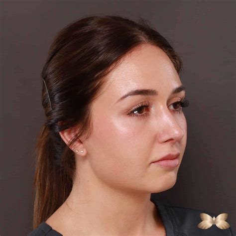 Rhinoplasty By Dr Thompson Utah Facial Plastics