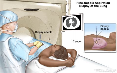 [figure Fine Needle Aspiration Biopsy Of The ] Pdq Cancer