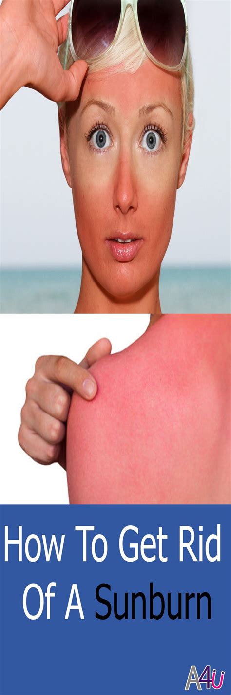 How To Get Rid Of A Sunburn 5 Amazing Home Remedies Get Rid Of