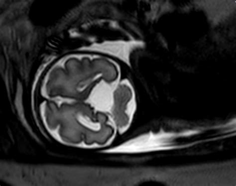 Fetal Arachnoid Cyst Philips Mr Body Map