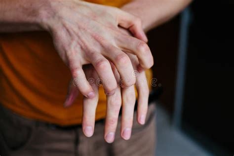 Man Scratch Oneself Dry Flaky Skin On Hand With Psoriasis Vulgaris