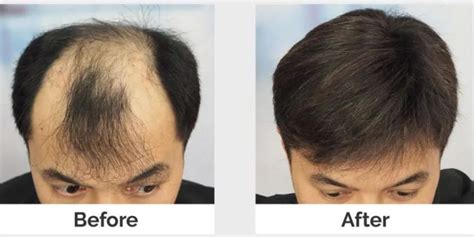 Hair Transplant Malaysia Professional Trusted And Affordable