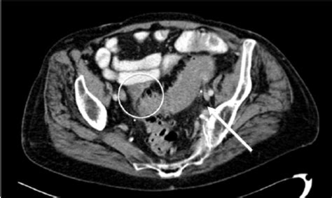 What Is Diverticulosis In The Sigmoid Colon