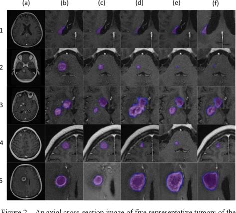 Figure 2 From A Cascaded Deep Learning Framework For Segmentation Of