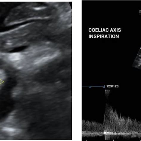 -(A): Ultrasound Abdomen image shows the origin of celiac artery from... | Download Scientific ...