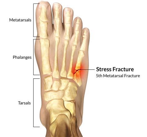 5th metatarsal avulsion fracture – Artofit