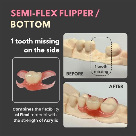 Semi-Flex Flipper for up to 3 Teeth Dental Solution