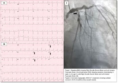 Right Bundle Branch Block With Severe Right Precordial St Segment Depression Stemi Or Nstemi