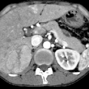 Contrast Enhanced Abdominal Computed Tomography A Wellcircumscribed