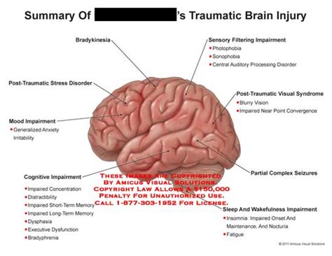 Amicus Illustration Of Amicusinjurybraintraumaticbradykinesiapost