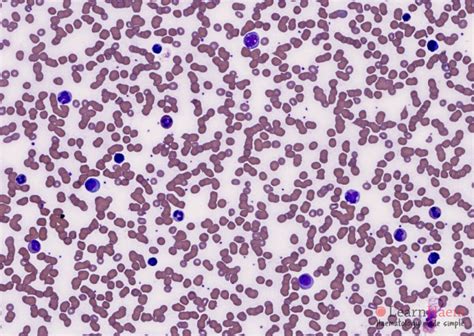 Plasma Cell Leukaemia Learnhaem Haematology Made Simple