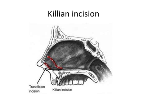 Endoscopic Single Handed Septoplasty With Batten Graft For Caudal Ppt