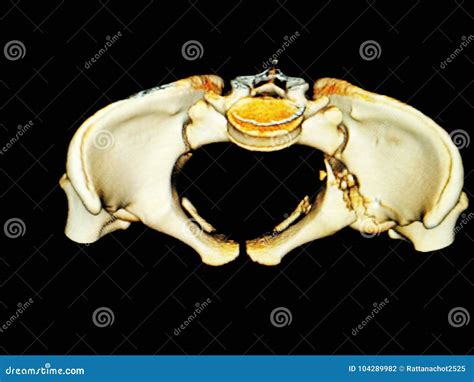 Ct Scan D Pelvis Stock Photo Image Of Ctscan Pelvis