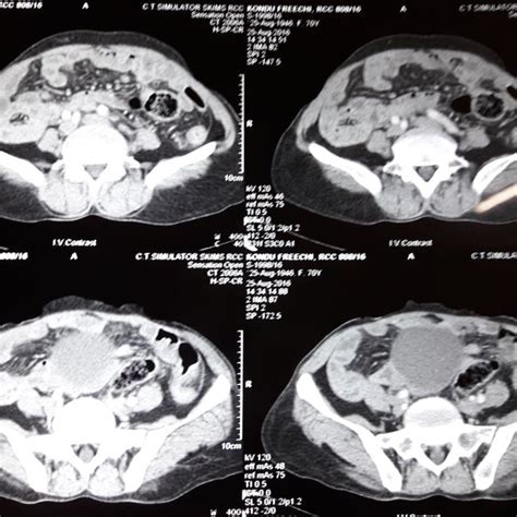 Cect Abdomen Showing Lymphadenopathy Download Scientific Diagram