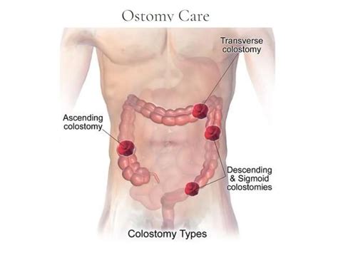 colostomy care APPLICATION PROCEDURE.pptx