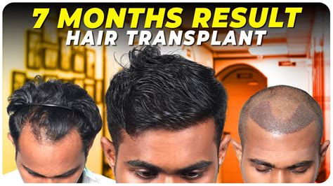 Hair Transplant In Nepal Best Results And Cost Of Hair Transplant In