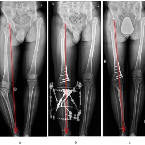 A Year Old Man With Post Traumatic Valgus Deformity Of The Left