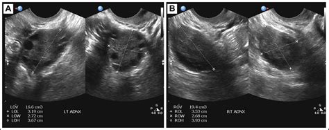 Polycystic Ovary Syndrome And Incidental Diagnosis Of Mosaic Turner